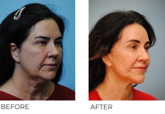 55-64 year old woman treated with Facelift 1 year ago
