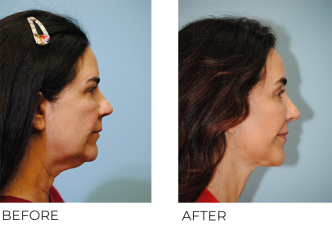 55-64 year old woman treated with Facelift 1 year ago