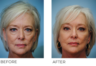 55-64 year old woman treated with Facelift 3 weeks ago A
