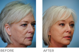 55-64 year old woman treated with Facelift 3 weeks ago
