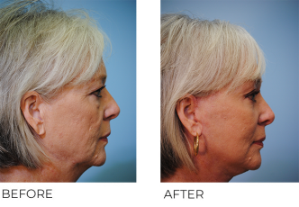 55-64 year old woman treated with Facelift 3 weeks ago