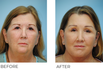 55-64 year old woman treated with Facelift 6 weeks ago