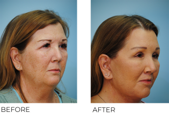 55-64 year old woman treated with Facelift 6 weeks ago