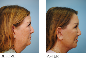 55-64 year old woman treated with Facelift 6 weeks ago