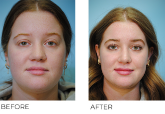 18-24 year old woman treated with Rhinoplasty 3 months ago