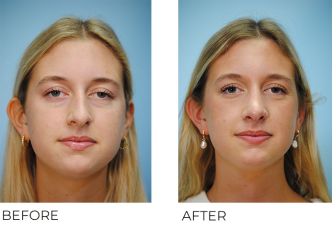 18-24 year old woman treated with Rhinoplasty 3 months ago