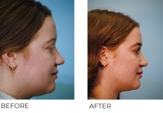 18-24 year old woman treated with Rhinoplasty 3 months ago
