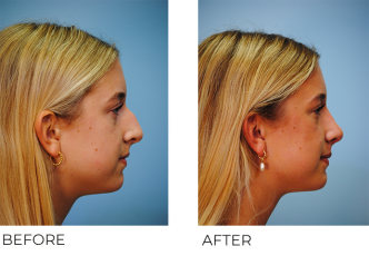 18-24 year old woman treated with Rhinoplasty 3 months ago