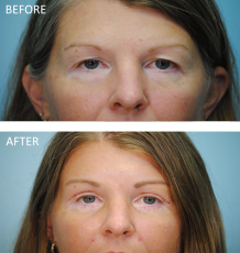 45-54 year old woman treated with Blepharoplasty 1 week ago
