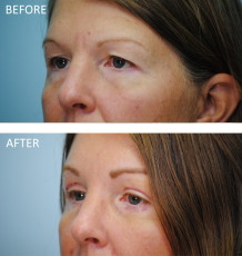 45-54 year old woman treated with Blepharoplasty 1 week ago