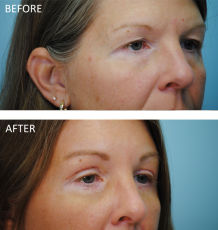 45-54 year old woman treated with Blepharoplasty 1 week ago