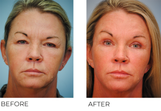 45-54 year old woman treated with Facelift 4 months ago