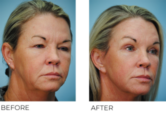 45-54 year old woman treated with Facelift 4 months ago