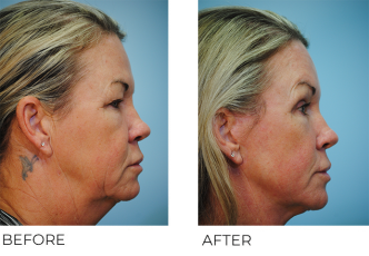 45-54 year old woman treated with Facelift 4 months ago C