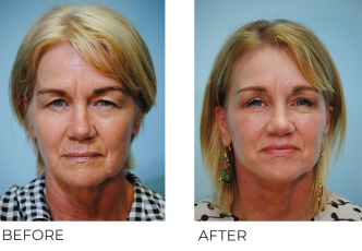 55-64 year old woman treated with Facelift 1 month ago