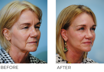 55-64 year old woman treated with Facelift 1 month ago