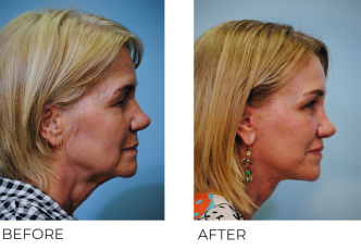 55-64 year old woman treated with Facelift 1 month ago