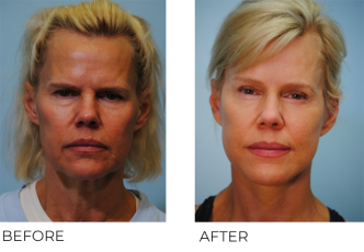 55-64 year old woman treated with Facelift 6 months ago