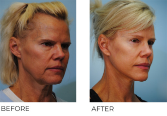 55-64 year old woman treated with Facelift 6 months ago