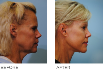 55-64 year old woman treated with Facelift 6 months ago