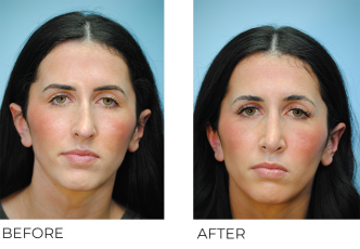 18-64 year old woman treated with Rhinoplasty 2 months ago