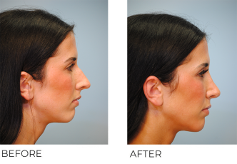 18-64 year old woman treated with Rhinoplasty 2 months ago
