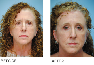 55-64 year old woman treated with Facelift 3 months ago