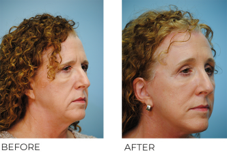 55-64 year old woman treated with Facelift 3 months ago