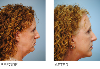 55-64 year old woman treated with Facelift 3 months ago