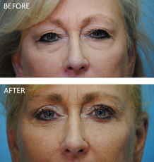 65-74 year old woman treated with Browlift 6 months ago