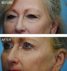 65-74 year old woman treated with Browlift 6 months ago