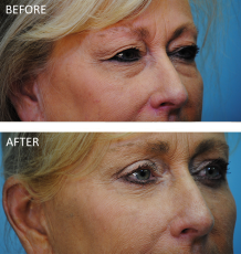 65-74 year old woman treated with Browlift 6 months ago C