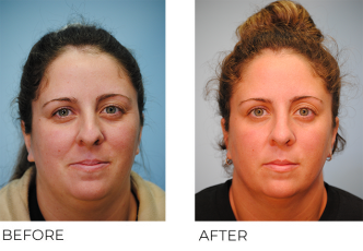 25-34 year old woman treated with Rhinoplasty 3 months ago