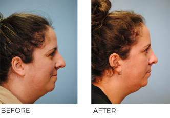 25-34 year old woman treated with Rhinoplasty 3 months ago