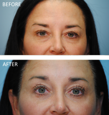 45-54 year old woman treated with Blephs 4 months ago