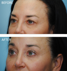 45-54 year old woman treated with Blephs 4 months ago