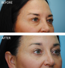 45-54 year old woman treated with Blephs 4 months ago