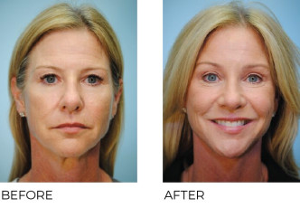 45-54 year old women treated with Facelift 1 month ago