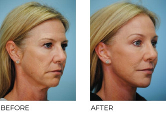 45-54 year old women treated with Facelift 1 month ago