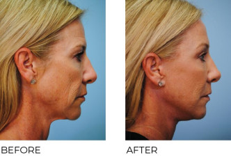 45-54 year old women treated with Facelift 1 month ago