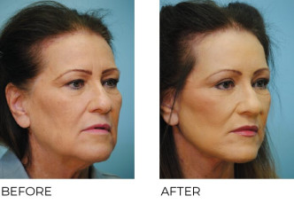 65-74 year old woman treated with Facelift 3 months ago