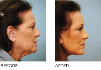 65-74 year old woman treated with Facelift 3 months ago