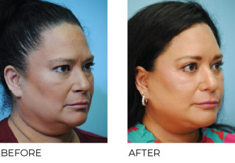 AENT-Before-Afters-2025_213_65-74_Side