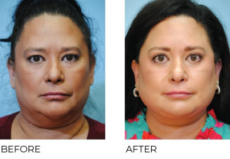 AENT-Before-Afters-2025_215_45-54_Front