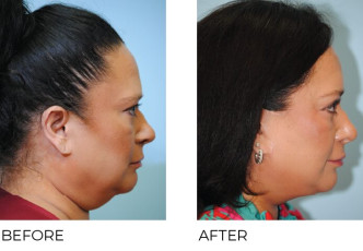 AENT-Before-Afters-2025_215_45-54_Oblique